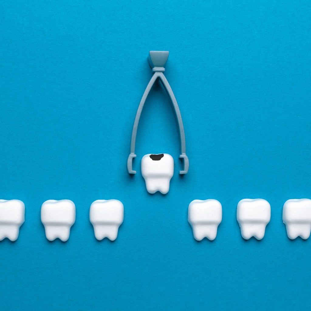 Extrakcia zuba